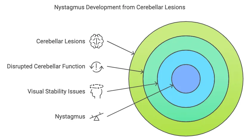 connection between Cerebellar Lesions and Nystagmus